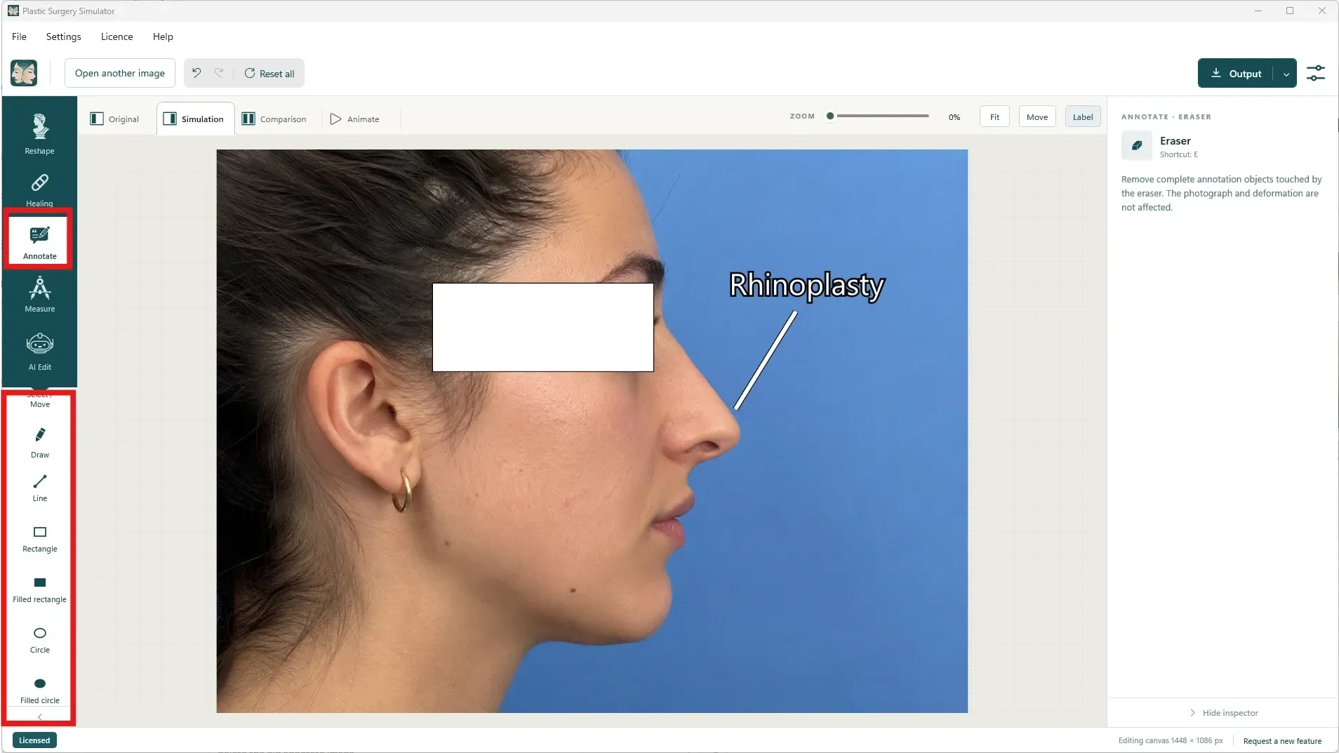 O modo Anotar com suas ferramentas de desenho à esquerda, e uma simulação de rinoplastia com o rótulo Rinoplastia, uma linha apontando para o nariz e um retângulo branco preenchido cobrindo os olhos