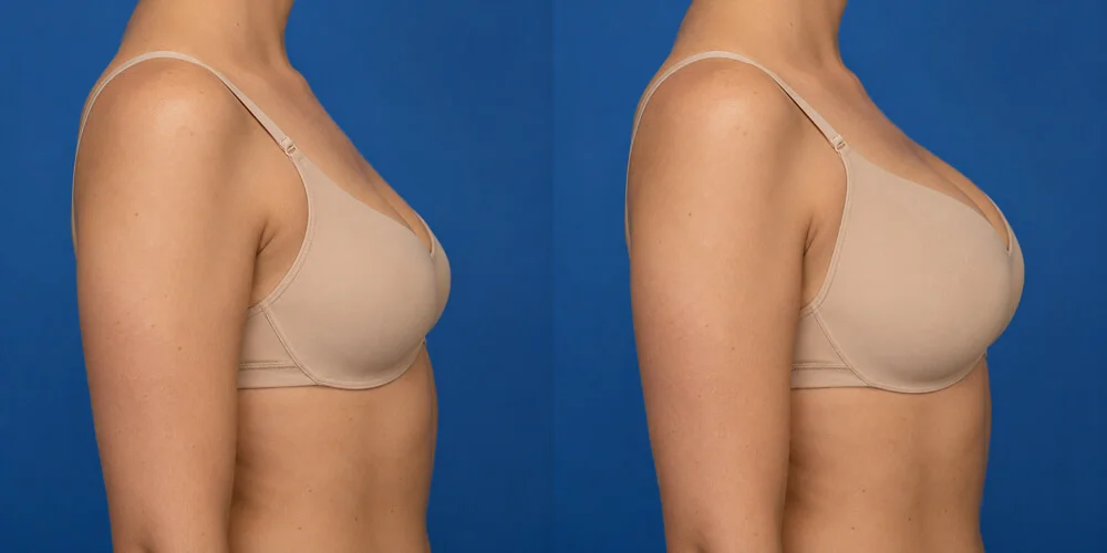 Breast augmentation simulated with Plastic Surgery Simulator