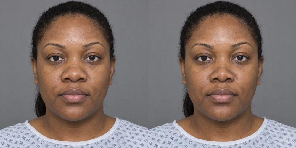 Ethnic rhinoplasty simulated with Plastic Surgery Simulator