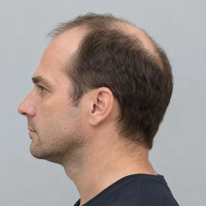 Thinning hair before AI Edit