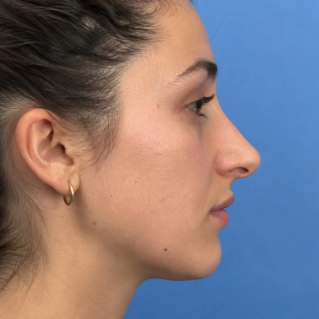 Rhinoplasty profile after reshaping with Push