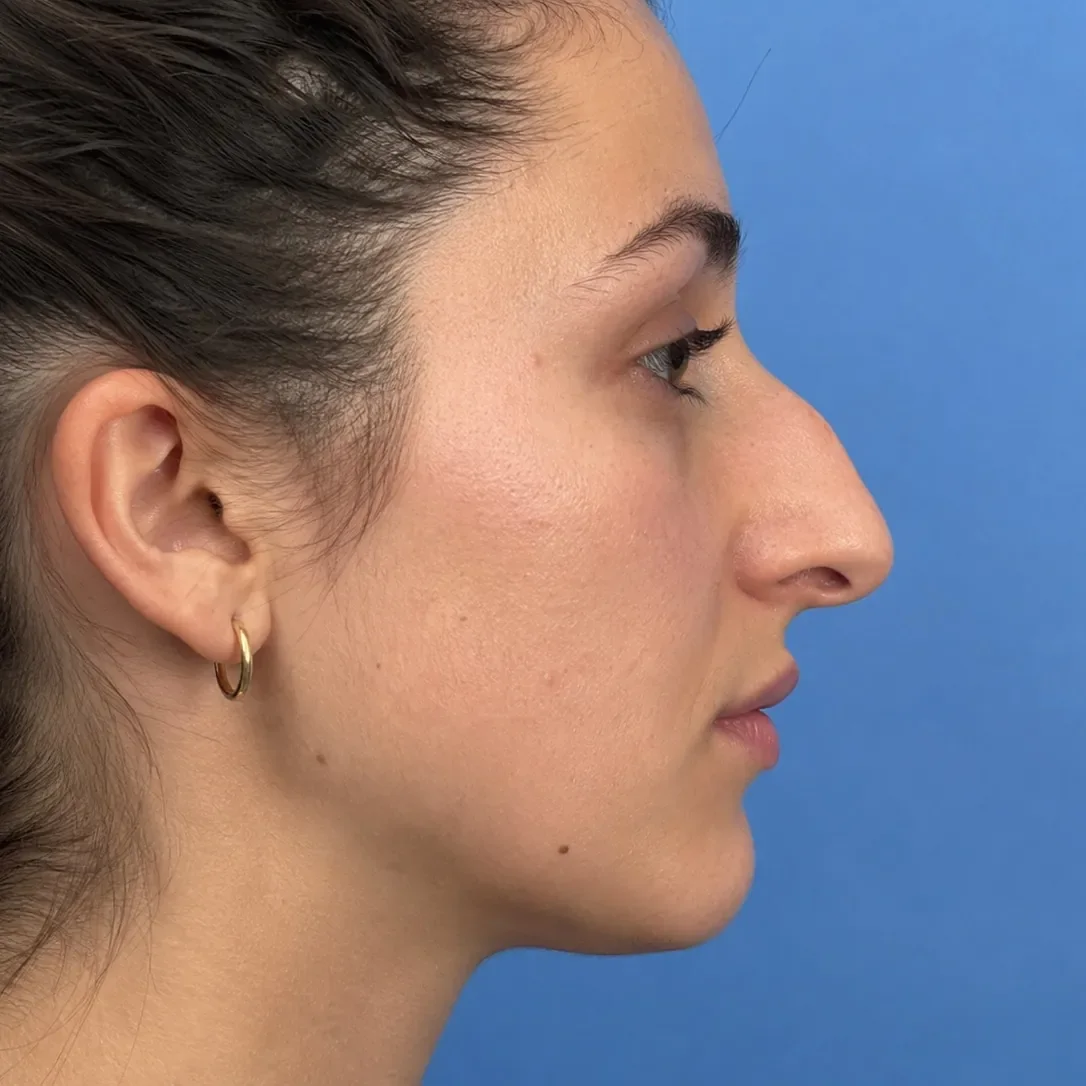 Comparação lado a lado salva de um perfil de rinoplastia, original e simulação