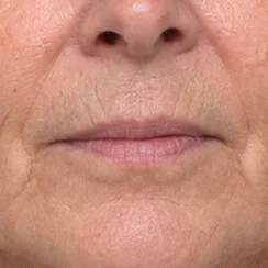 Wrinkles around the mouth