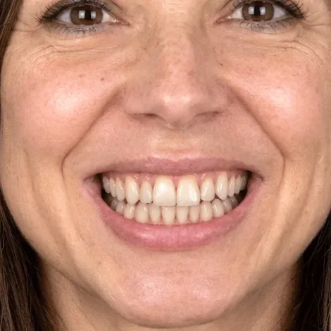 The same smile with even, refined teeth after the AI Edit veneers simulation