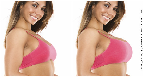 Breast augmentation