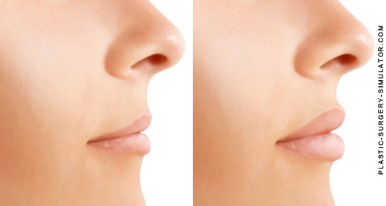 Lips augmentation