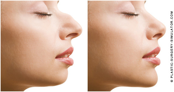 Rhinoplasty & Chin