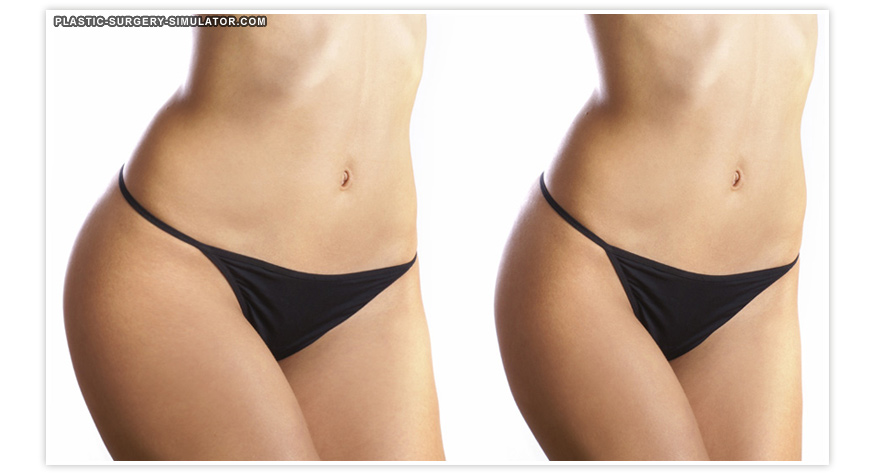 Plastic Surgery Simulator로 시뮬레이션한 지방 조각술