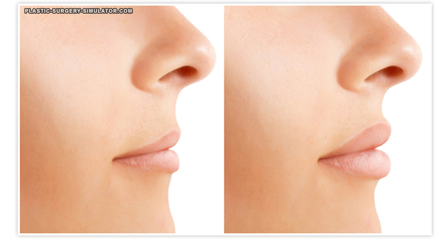 Plastic Surgery Simulator로 시뮬레이션한 입술 확대