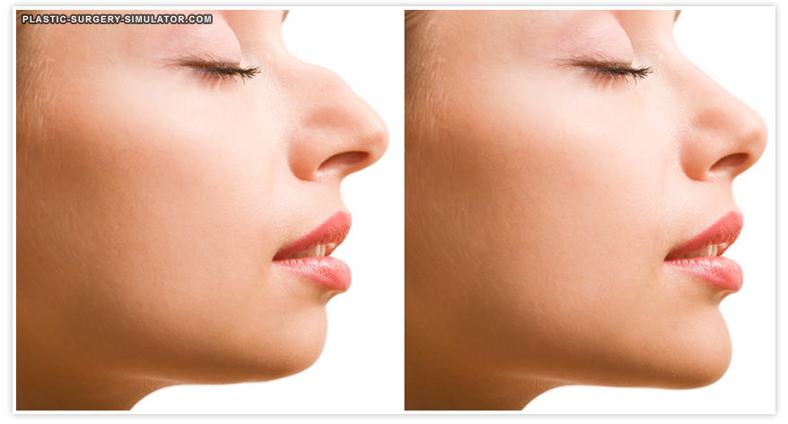 Plastic Surgery Simulator로 시뮬레이션한 코 성형