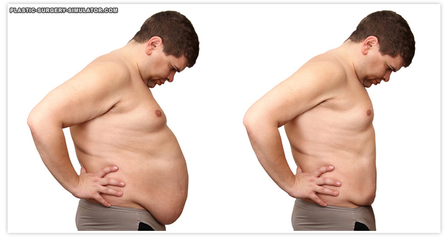 Plastic Surgery Simulator로 시뮬레이션한 복부 성형