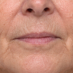 Original skin with wrinkles around the mouth