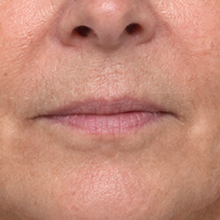 Same skin after wrinkle removal with Spot healing