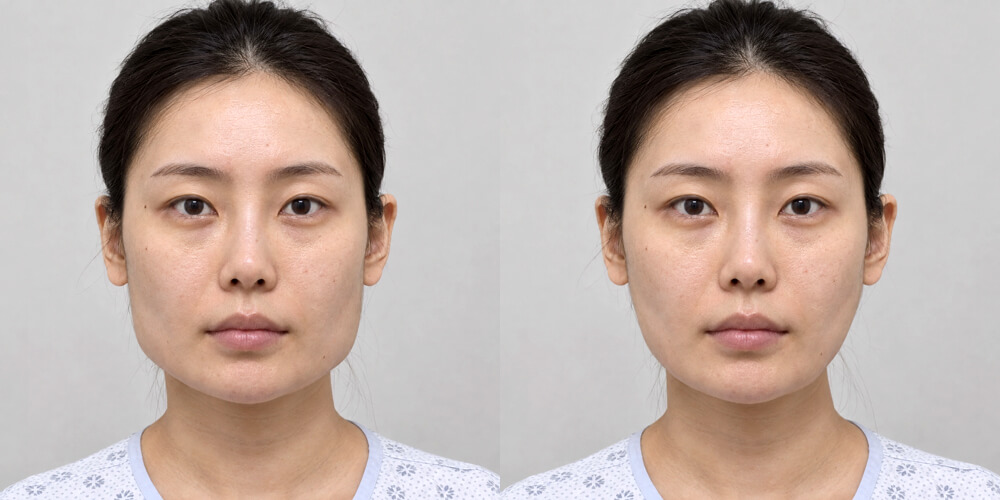 Remodelage du visage - Réduction de la mâchoire — Avant / Après
